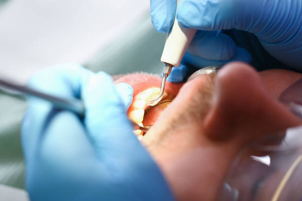Best Emergency Tooth Extraction in Hampton, TN